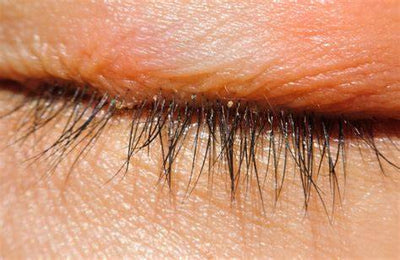 Demodex Blepharitis: The Complete Guide to Eyelid Mites