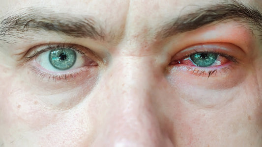 The 3 Types of Blepharitis — Bacterial, Seborrhoeic and Demodex — and Where Castor Oil Fits In