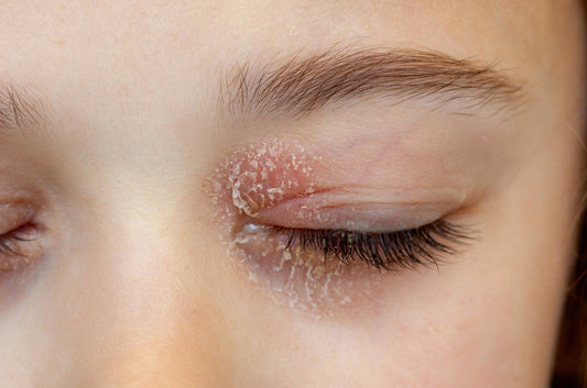 Cylindrical Dandruff and Eyelash Crusting: What They Mean and How to Clear Them