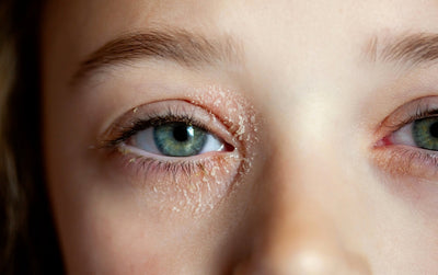 Blepharitis and Dry Eye: Why They're Connected and How to Treat Both
