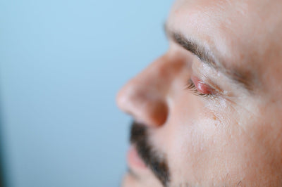 Demodex Mites, Rosacea and Your Eyes: The Connection